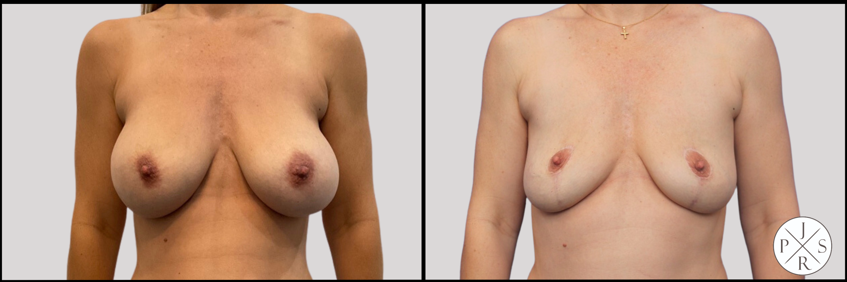 Breast Implant Removal Before & After Image